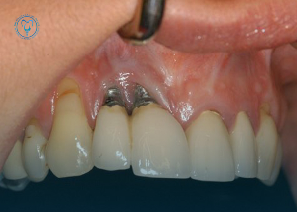 لق شدن ایمپلنت دندان لق شدن ایمپلنت دندان