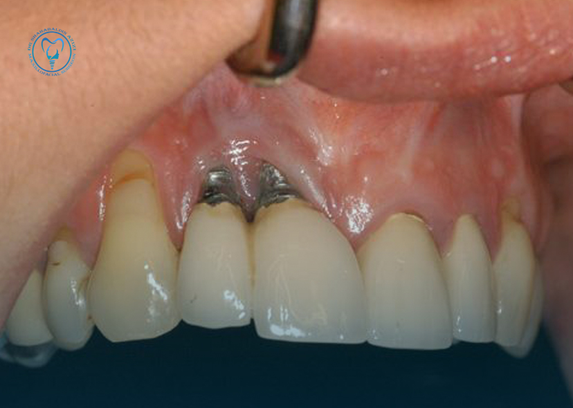 لق شدن ایمپلنت دندان