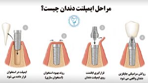 مراحل ایمپلنت