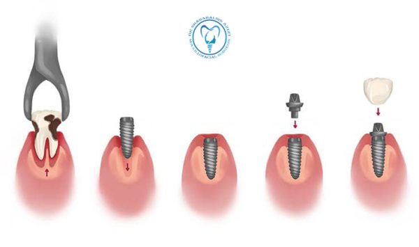 مراحل ایمپلنت دندان مراحل ایمپلنت دندان