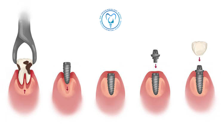 مراحل ایمپلنت دندان