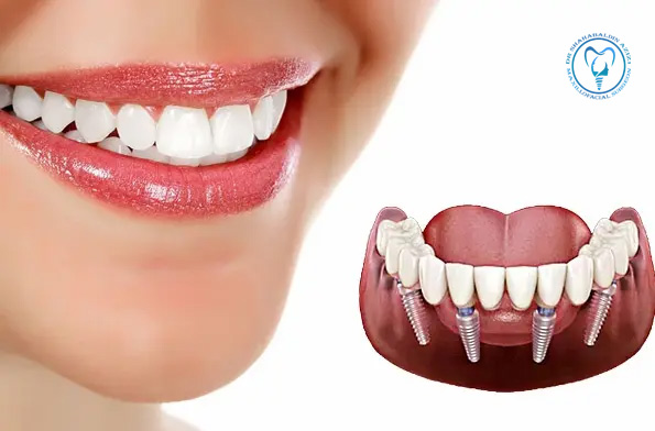 مراقبت‌های قبل از ایمپلنت دندان