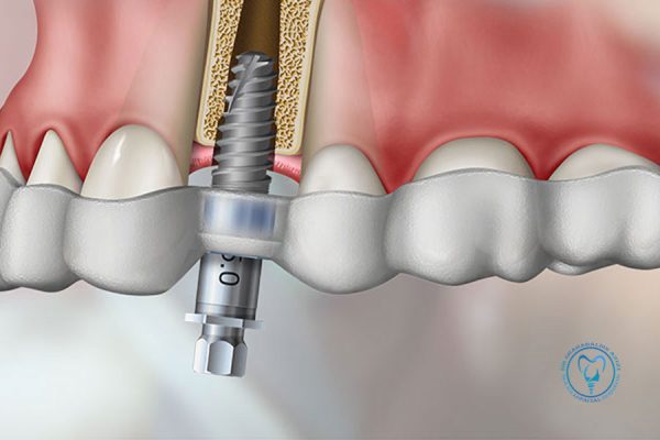 گاید جراحی ایمپلنت گاید جراحی ایمپلنت