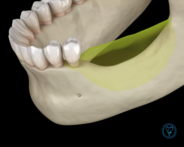 آیا ایمپلنت باعث تحلیل استخوان می‌شود