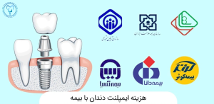 پرداخت بیمه برای ایمپلنت