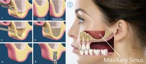 تحلیل استخوان فک بعد از ایمپلنت