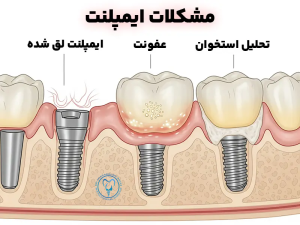 مشکلات ایمپلنت