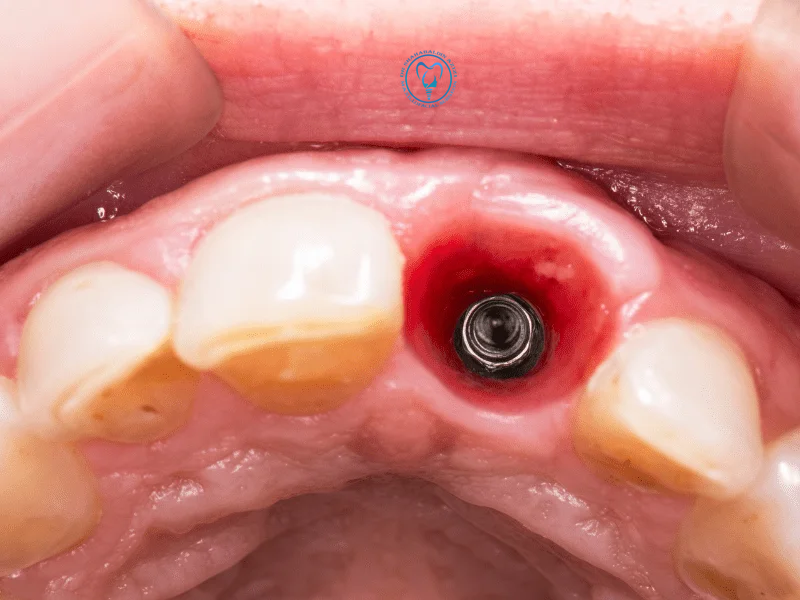 فرایند جوش خوردن ایمپلنت با استخوان