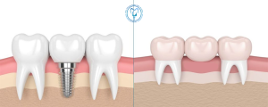 مقایسه ایمپلنت با بریج دندان