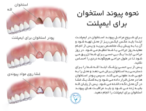 مراحل پیوند استخوان برای ایمپلنت دندان