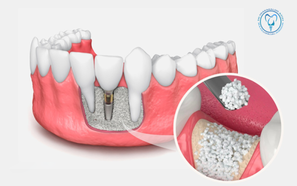چرا برخی ایمپلنت‌ها نیاز به پیوند استخوان دارند؟