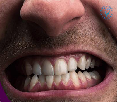 اثر استرس و فشارهای فکی بر ایمپلنت