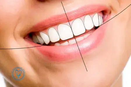 اصلاح طرح لبخند با ایمپلنت و لمینت همزمان