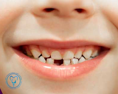 ایمپلنت دندان برای نوجوانان