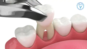 ایمپلنت دندان عقل