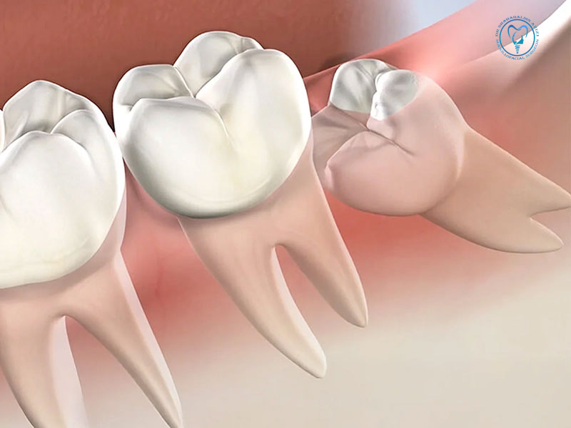 چه زمانی ایمپلنت جایگزین دندان عقل می‌شود؟