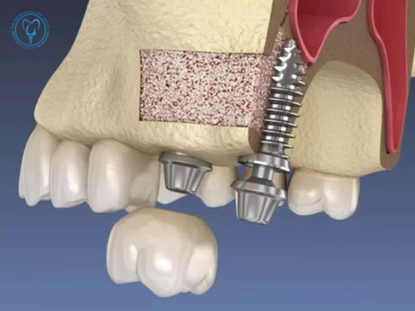 آیا ایمپلنت در فک بالا سخت‌تر است؟