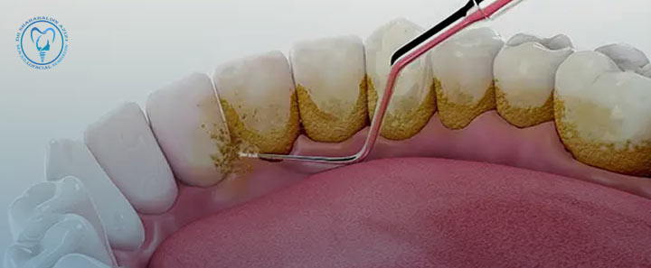 آیا ایمپلنت دندان نیاز به جرم‌گیری دارد؟