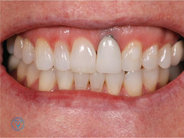 بررسی عوامل شکست ایمپلنت