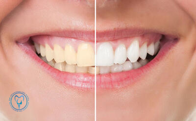 خطرات استفاده از ایمپلنت ارزان و غیراستاندارد