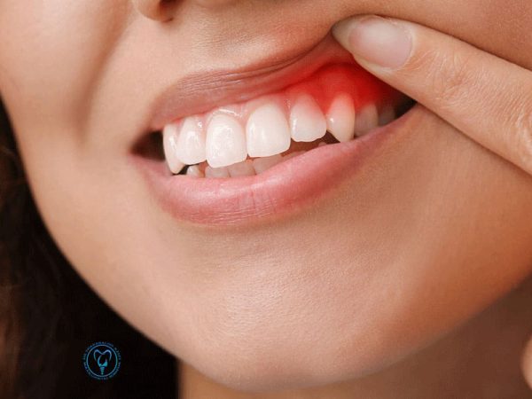 درمان التهاب لثه دور ایمپلنت دندان