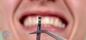 ایمپلنت فک بالا