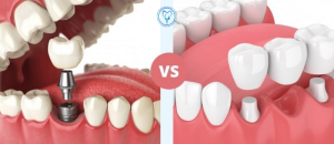 ایمپلنت یا پل دندان؟