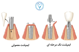 انواع روش ایمپلنت دندان