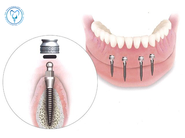 ایمپلنت در شرایط خاص فک کوچک یا نازک