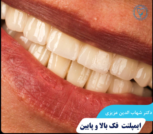 فول ایمپلنت