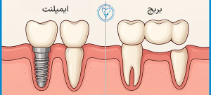 تفاوت بریج و ایمپلنت دندان