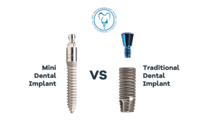 مینی ایمپلنت دندان