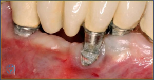 تشخیص پری ایمپلنتس