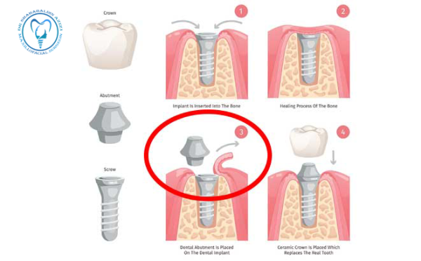 اکسپوز ایمپلنت چیست؟