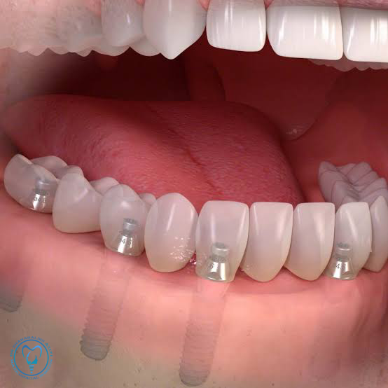 ایمپلنت در فک بالا سخت‌تر است یا فک پایین؟