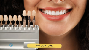 روکش ایمپلنت دندان پی اف ام