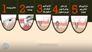 مراحل ایمپلنت دندان