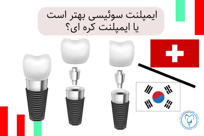 ایمپلنت کره‌ای یا سوئیسی