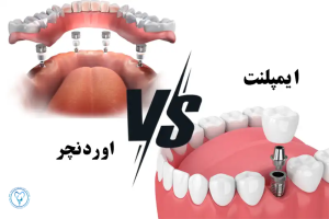 مقایسه ایمپلنت و اوردنچر