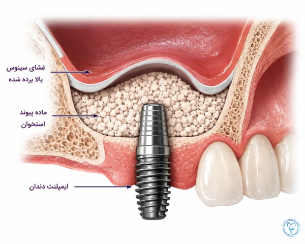جراحی افزایش استخوان فک