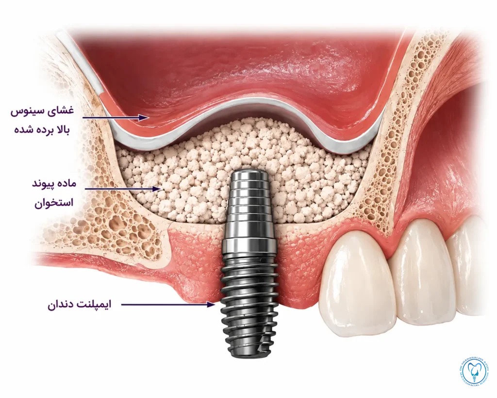 جراحی افزایش استخوان فک