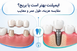 مقایسه ایمپلنت و بریج