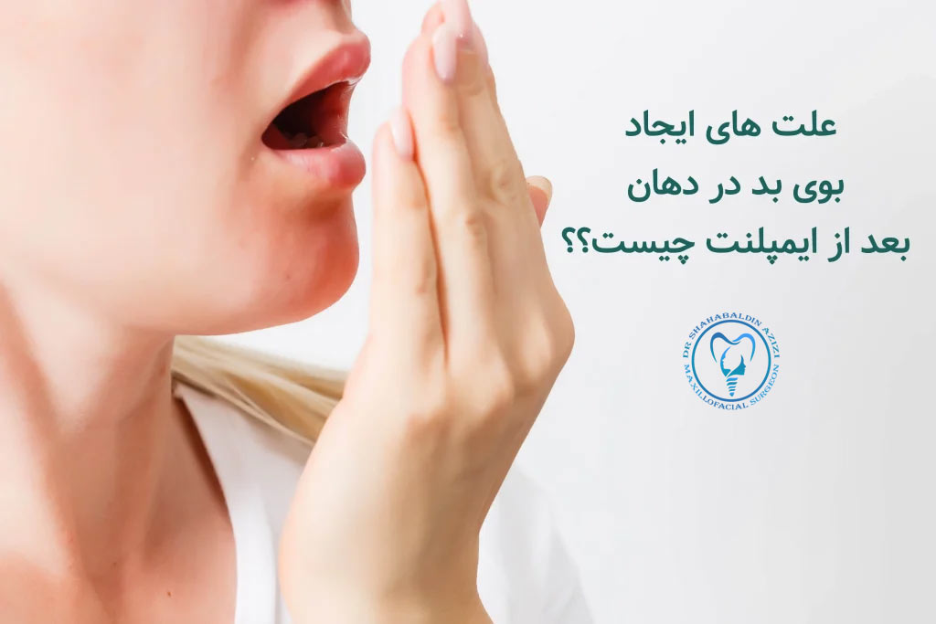 بوی بد دهان بعد از ایمپلنت