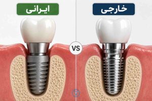 تفاوت ایمپلنت ایرانی و خارجی