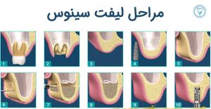مراحل سینوس لیفت
