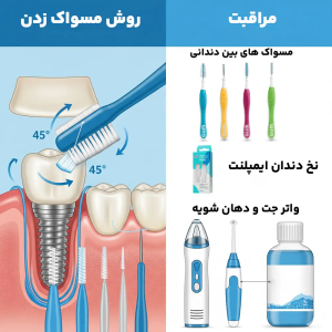 تمیز کردن ایمپلنت دندان