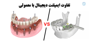 مقایسه ایمپلنت دیجیتال و سنتی