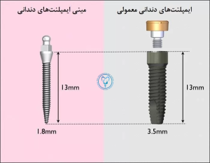مینی ایمپلنت و ایمپلنت معمولی